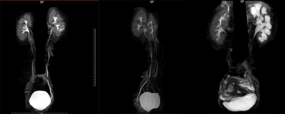 Magnetic Resonance Urography MRU Dubai Radiology Center MRI Scan
